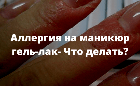 Аллергия на маникюр гель-лак - Что делать?