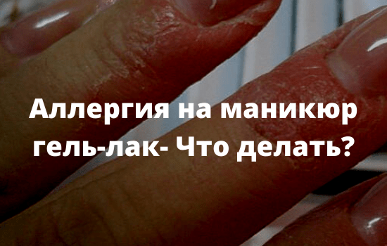 Аллергия на маникюр гель-лак - Что делать?